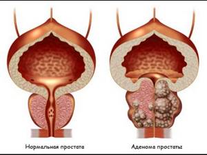 Аденома простаты у мужчин симптомы лечение без операции отзывы