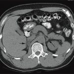 Альдостерома на снимке