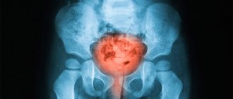 Bacterial cystitis