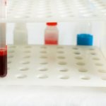 Биохимический анализ крови на креатинин и мочевину