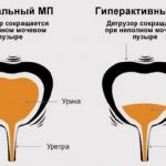 What is a neurogenic bladder