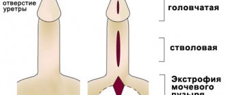 Epispadias - symptoms and treatment, photos and videos.