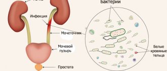 Гематурия инфекция схема