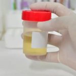 Как собирать и что показывает анализ мочи по Нечипоренко?