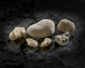 камни из почек человека