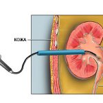 Литотрипсия