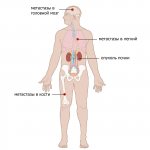 Метастатический рак почки