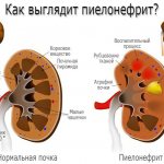Пиелонефрит