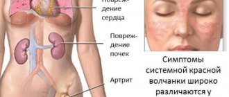 Поражение почек при системной красной волчанке