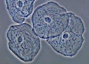 Повышены клетки плоского эпителия в моче
