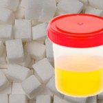 Правила сбора мочи на сахар, расшифровка результатов