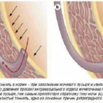 Причины и симптомы пузырно-мочеточникового рефлюкса
