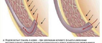 Причины и симптомы пузырно-мочеточникового рефлюкса