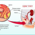 Causes of cystitis