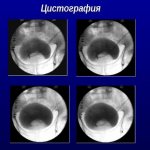 Примеры цистограмм