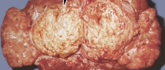 Kidney cancer