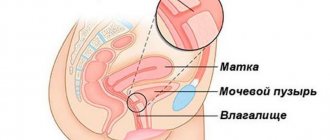 Rectovaginal fistulas