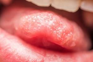 Симптомы папиллита языка
