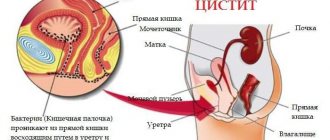 свечи при цистите