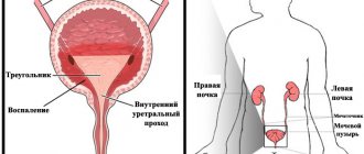 Тригонит мочевого пузыря