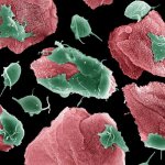 трихомоноз у мужчин