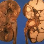 туберкулез почек