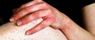уртикарная кожная сыпь