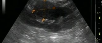 Ultrasound: Tumor of the right kidney