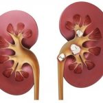 Узи почек мкд что это