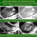 Is pyelonephritis visible on ultrasound?